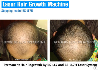 Saç Dökülmesi, Saç Büyüme Lazer Tedavisi İçin High End Lazer Işık Terapisi