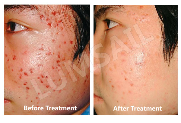 acne_before_after_3.jpg