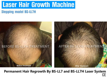 Saç Büyüme İçin Düşük Seviyeli Lazer Terapisi