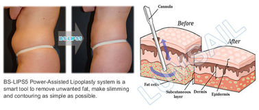 Uyluk / Silah / Sırt Arıtma İçin Güç Destekli Cerrahi Vakum Liposuction Kavitasyon Makinesi